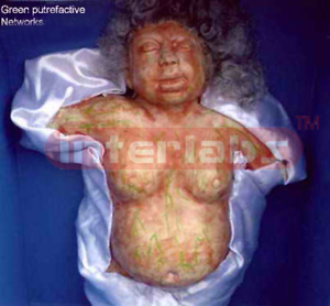 Putrefaction showing greenish discoloration